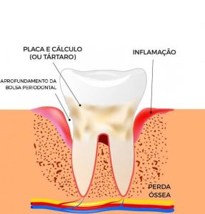 Processos da periodontite Ilustração para periodontite