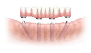 Implante Overdenture Imagem ilustrativa da instalação do Implante Overdenture