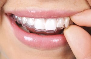 imagem demonstrativa Invisalign width= Invisalign imagem demonstrativa